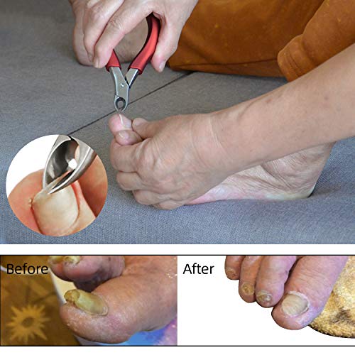 Toenail Clippers For Elderly, Used For Thick Toenails Fungi